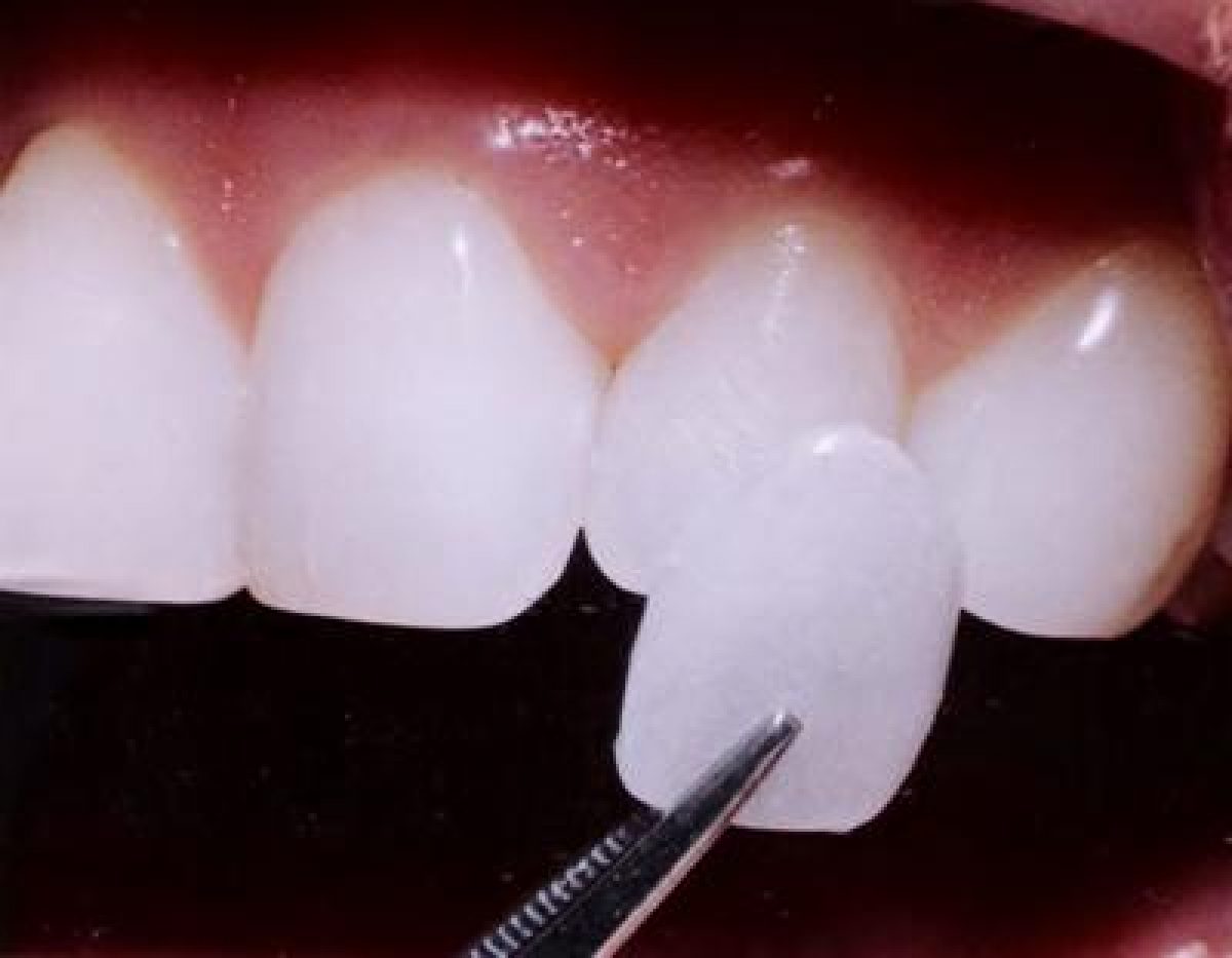 Curare i denti, cosa sono le faccette dentali? - Tenerifesurprise